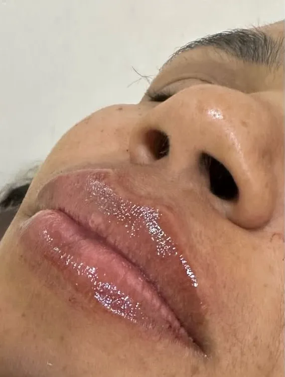 Depois do procedimento